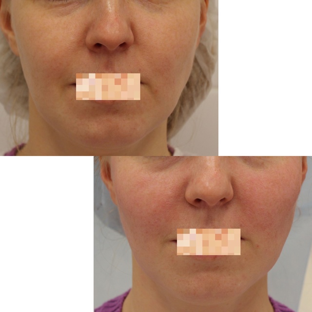 Нитевой лифтинг