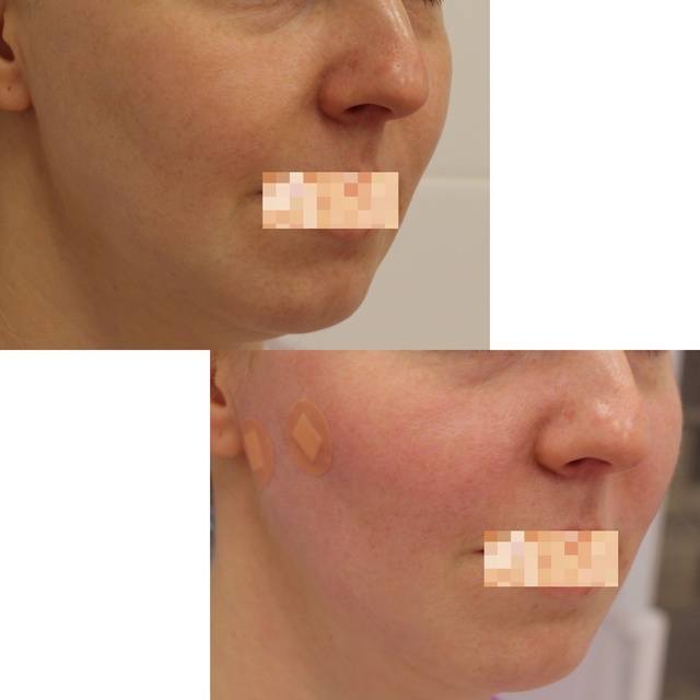 Нитевой лифтинг