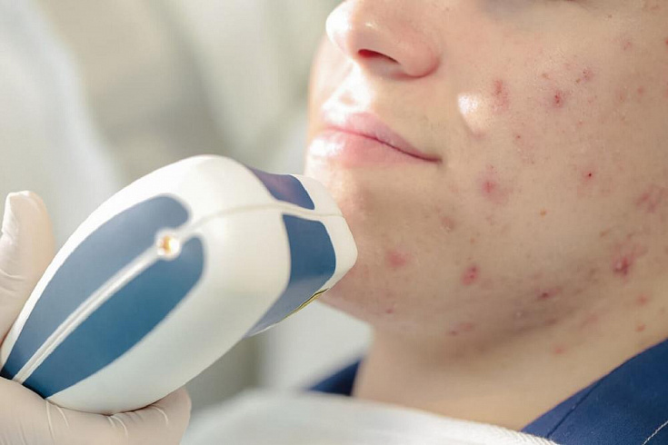 Лазерное лечение акне постакне